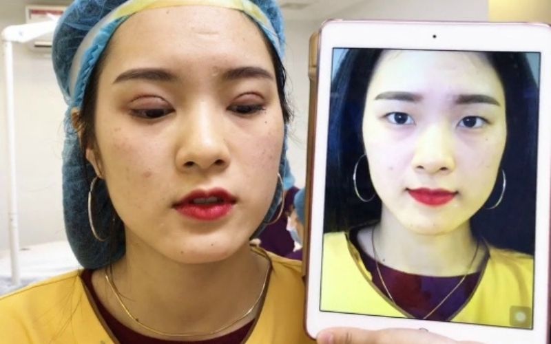 Nên cắt mí ở địa chỉ thẩm mỹ uy tín, tránh những nơi giá rẻ có rủi ro cao