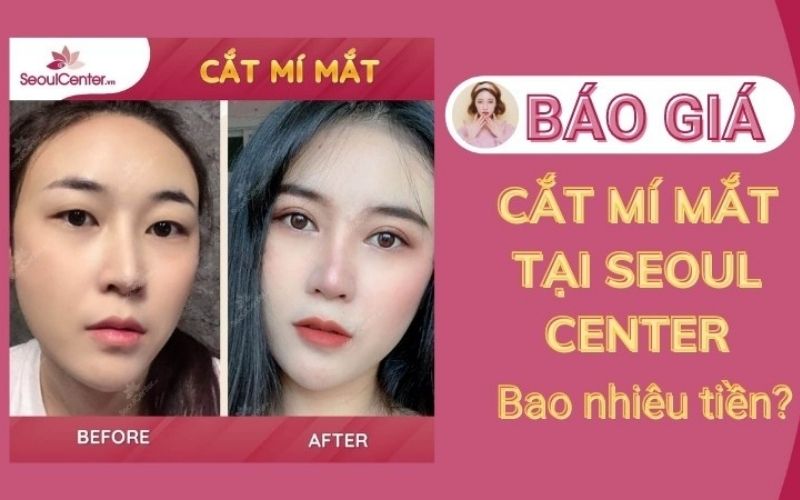 Giá cắt mí ở Seoul Center hợp với túi tiền của khách hàng