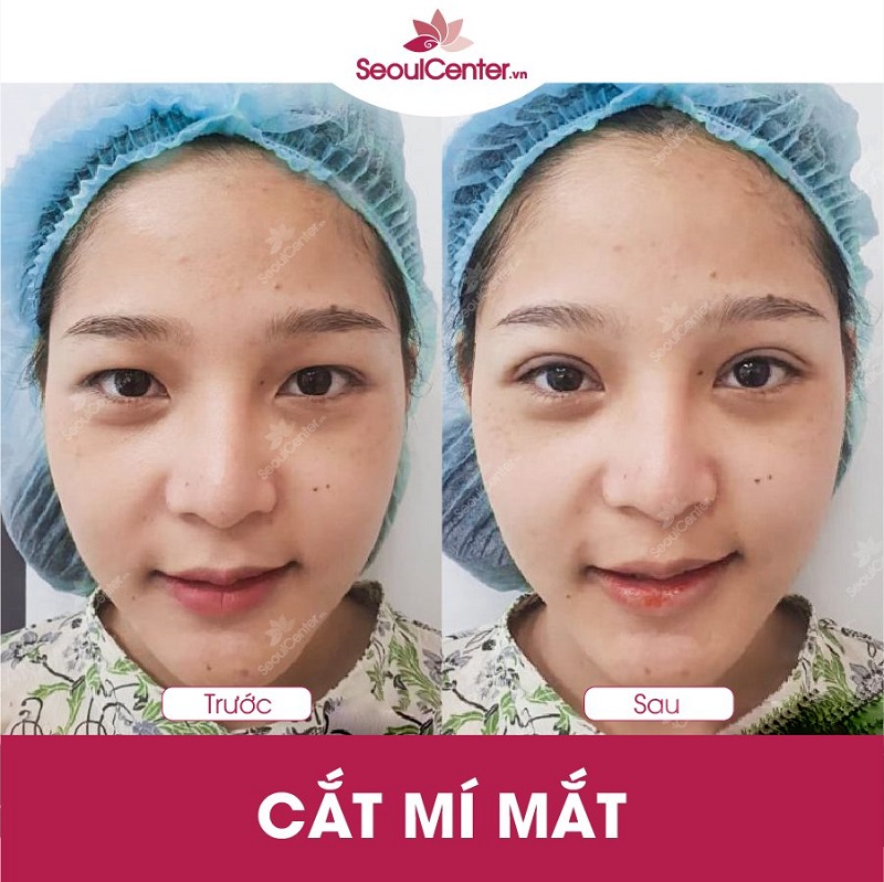 Cắt mí mang đến đôi mắt hai mí vô cùng tự nhiên