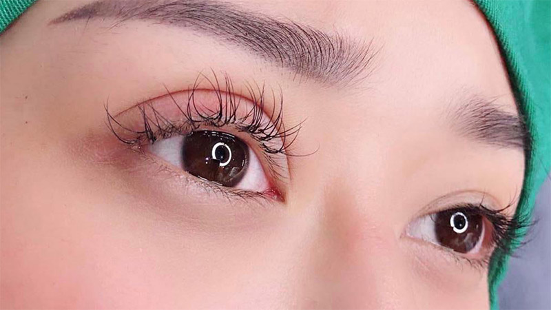 Mắt sưng nhẹ sau khi cắt mí là hiện tượng bình thường