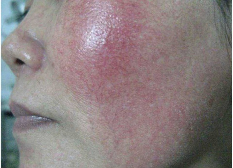 Da mặt sử dụng kem trộn không rõ nguồn gốc