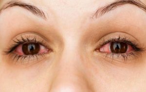 Mi bị gãy gây ảnh hưởng đến nhan sắc và cả đôi mắt