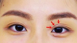 Cách chữa mắt 3 mí tại nhà nhanh chóng nhất