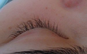 Tình trạng mi uốn bị sun