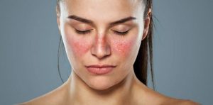 Da ửng đỏ là biểu hiện của làn da nhạy cảm