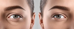 Cắt mí cần kiêng cữ khắt khe một số thực phẩm