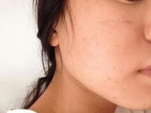 Tế bào da chết nhiều khiến làn da thâm sạm, không đều màu