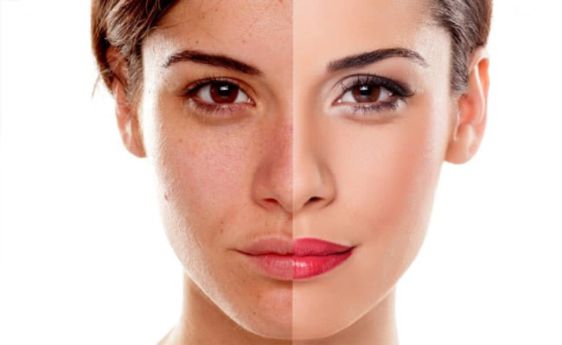 Lý do nào khiến cho những đốm thâm nám sậm màu xuất hiện trên bề mặt da