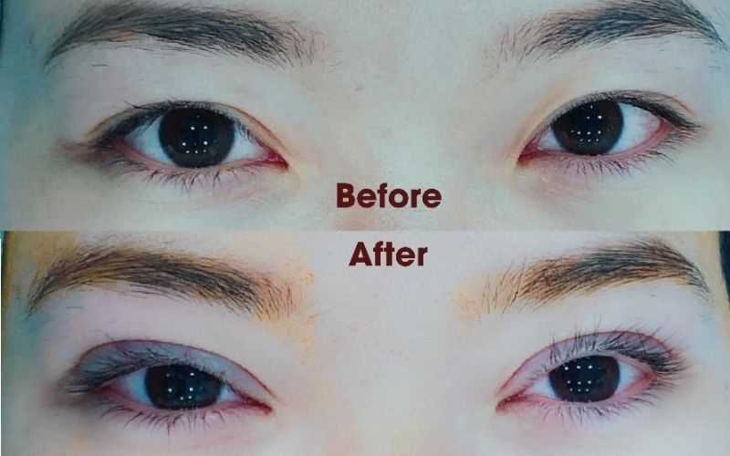 Mí mắt sau khi được chỉnh sửa rõ nét hơn