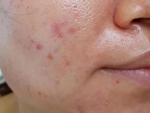 Tình trạng da dầu mụn, lỗ chân lông to