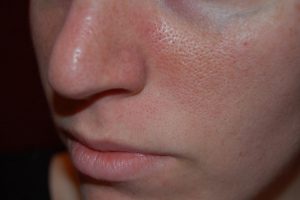 Có nhiều đặc điểm giúp nhận dạng da dầu, lỗ chân lông to