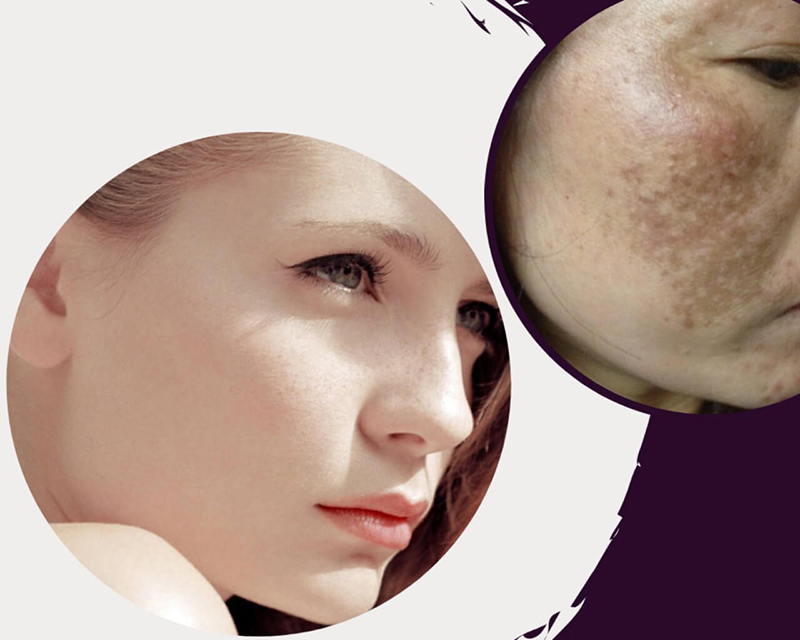 Cần loại bỏ tàn nhang càng sớm càng tốt tránh chúng trở nên nặng hơn và khó điều trị