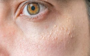 Mụn thịt gây mất thẩm mỹ da nhưng không tạo cảm giác đau nhức