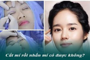 Cắt mí rồi có nhấn mí được không là thắc mắc của nhiều chị em