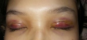 Trường hợp cắt mí hỏng khiến mí mắt bị sưng đỏ tấy và mưng mủ