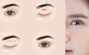 Cắt mí mắt loại bỏ được mỡ thừa, da chùng hiệu quả