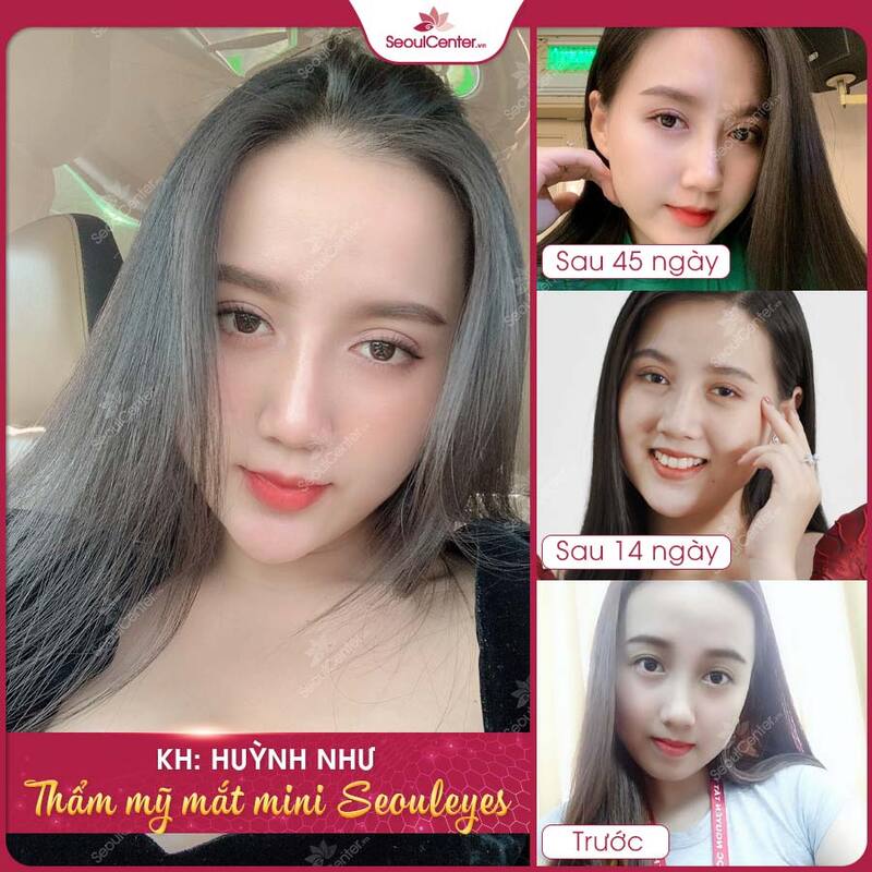Khách hàng sở hữu đôi mắt 2 mí chỉ sau 45 ngày tại Seoul Center