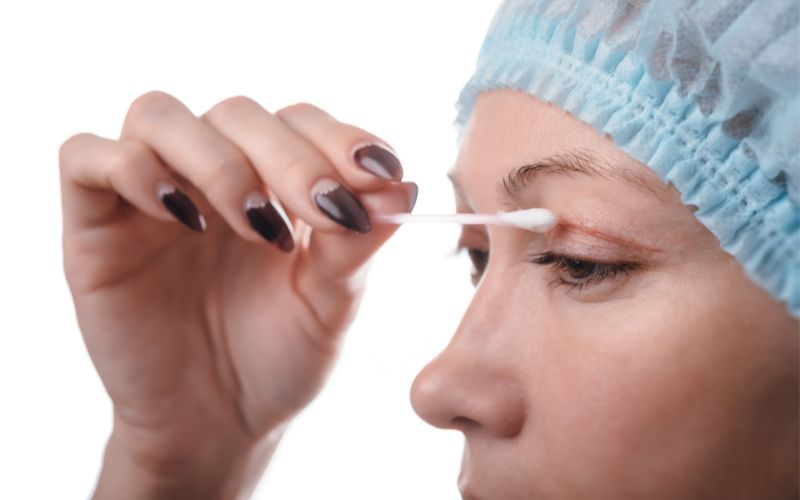 Vết thương sau cắt mí cần được chăm sóc cẩn thận