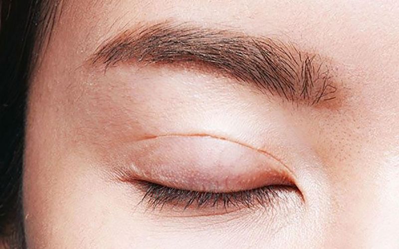 Cắt mí cần ít nhất 1 tuần đầu tiên để hồi phục