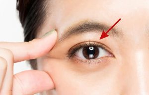 Cắt chỉ mí mắt có đau không?