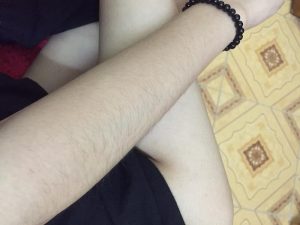 Có nhiều nguyên nhân khiến lông mọc nhiều ở tay