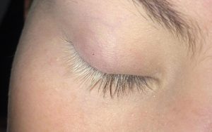 Nguyên nhân hình thành lông mi màu trắng có rất nhiều