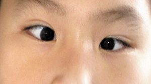 Đôi mắt của bạn có thể bị lé kim do nhiều nguyên nhân khác nhau