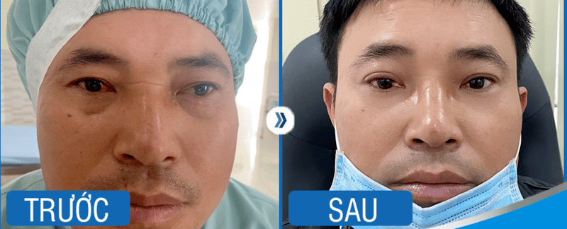Đôi mắt đã trở về trạng thái bình thường hậu phẫu thuật