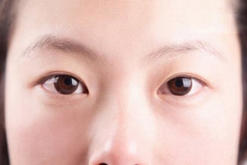 Số phận, cuộc đời của những người có mắt mí lót không mấy may mắn, suôn sẻ