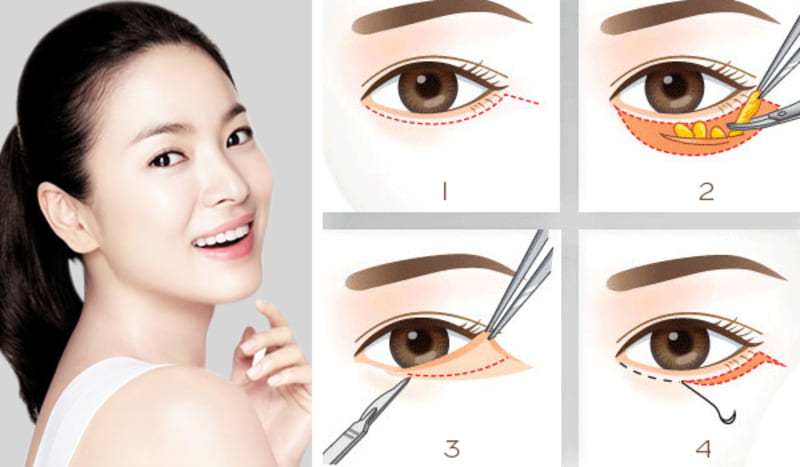 Cắt mí là thủ thuật đơn giản khắc phục nhược điểm đôi mắt kém thẩm mỹ