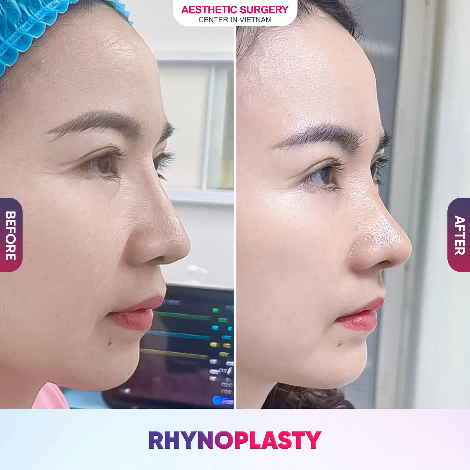https://cdn.diemnhangroup.com/aestheticsurgeryvietnam.com/2025/07/AFTER__17.webp