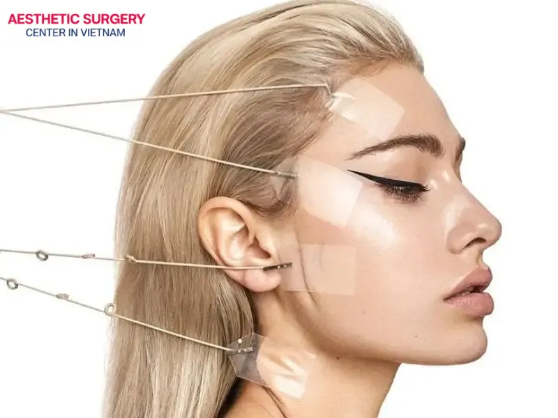 Collagen thread lifting uses safe threads to effectively contour and define facial features