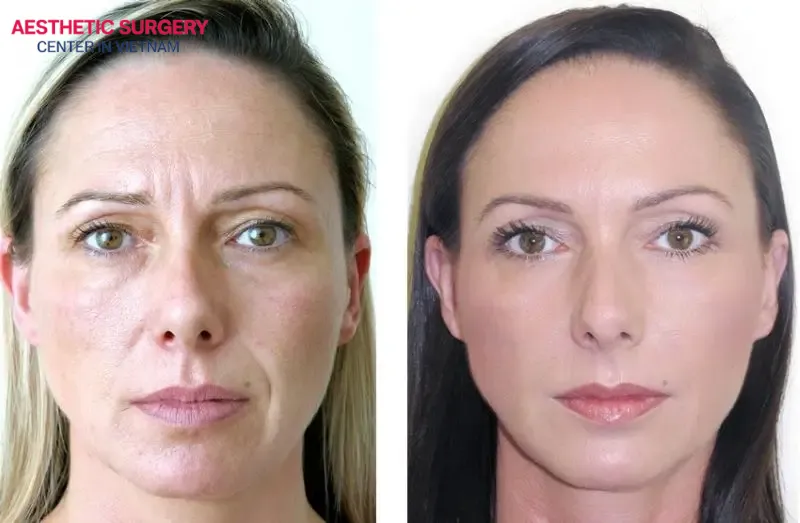 A client’s appearance shows a remarkable transformation, looking noticeably more youthful after the filler injection