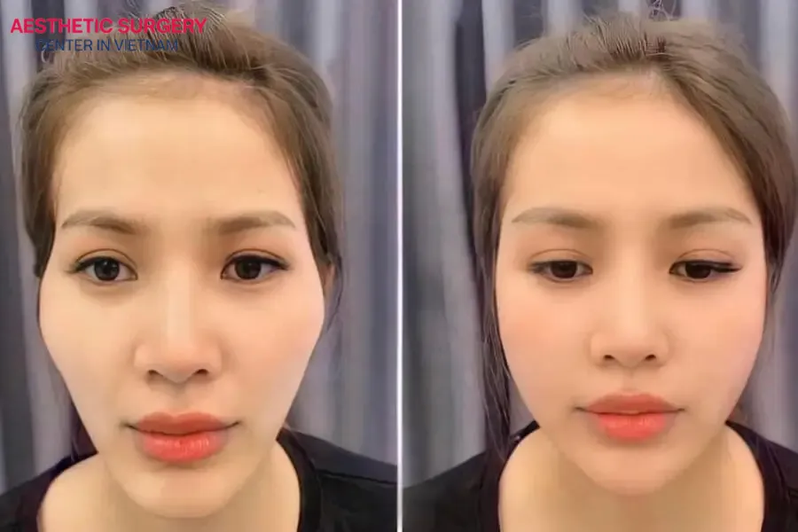 Filler injections help fill sunken areas like the cheeks and temples, resulting in a more balanced appearance