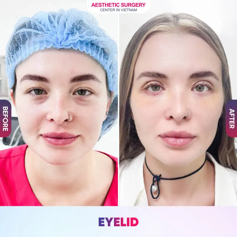 https://cdn.diemnhangroup.com/aestheticsurgeryvietnam.com/2025/07/Olya-BF.webp