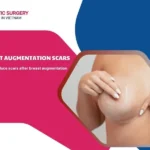 breast augmentation scars