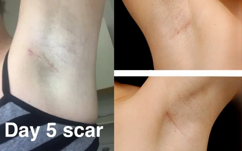Transaxillary scars are easily visible and can be exposed on the underarm area when wearing sleeveless clothing