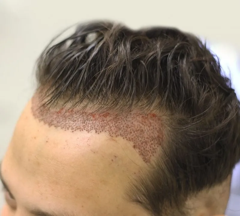 Hair transplant helps your hair become thicker and fuller