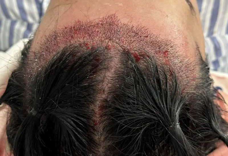 Results after 2 weeks of hair transplant