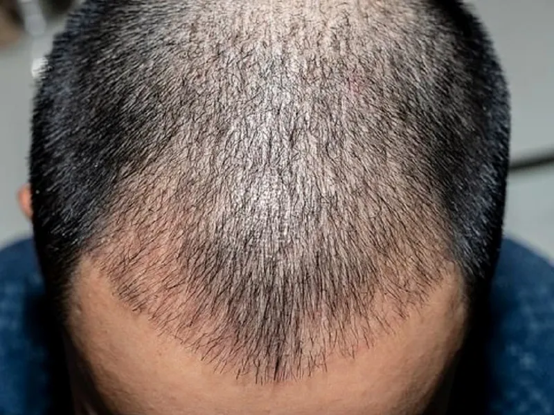 Results after 4 months of hair transplant