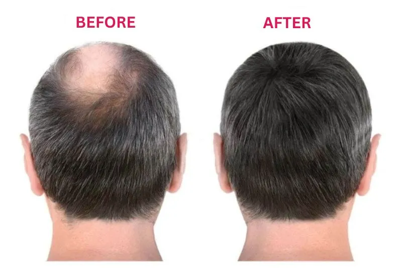 Results after 12 to 18 months of hair transplant