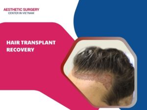 hair-transplant-recovery-