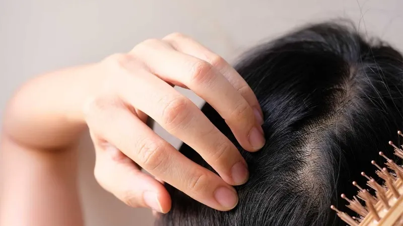 Post-transplant hair care plays an important role