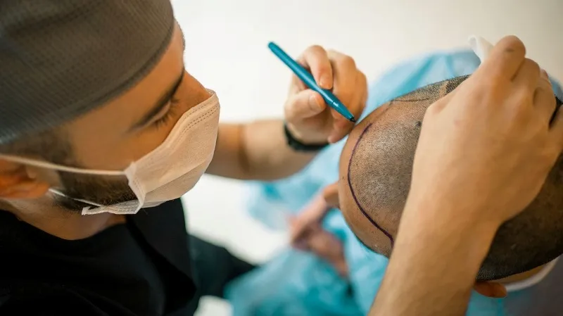 Hair transplant final results depend greatly on the surgeon’s expertise