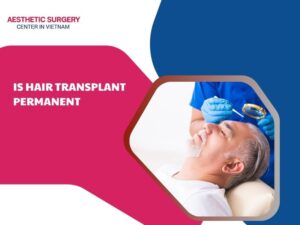 is-hair-transplant-permanent