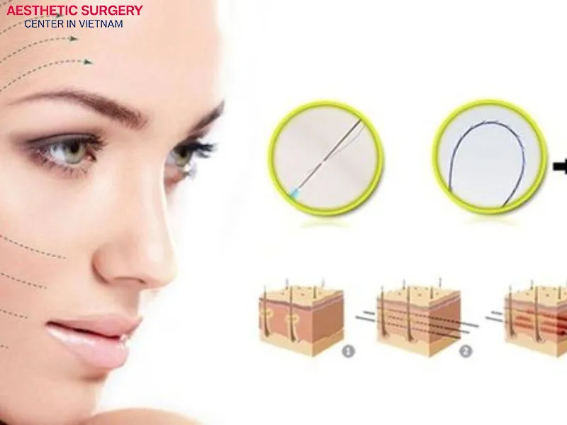 Nonsurgical facelift is completely non-invasive, making it extremely safe