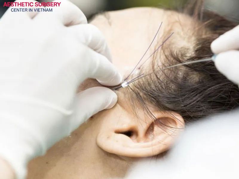 Collagen thread lifting is a long-lasting solution that keeps skin firm and radiant