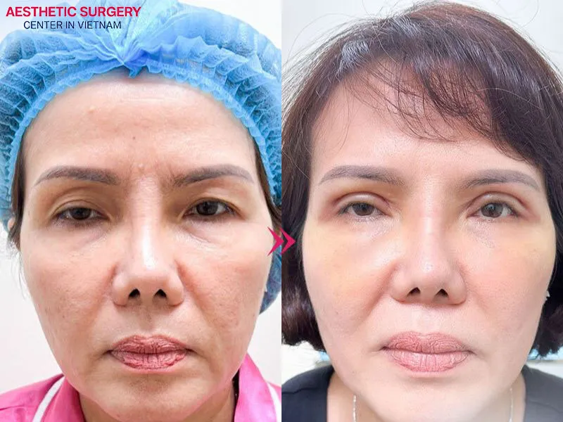 Aesthetic Surgery Center is proud to be a provider of effective and safe nonsurgical facelift services for both domestic and international clients