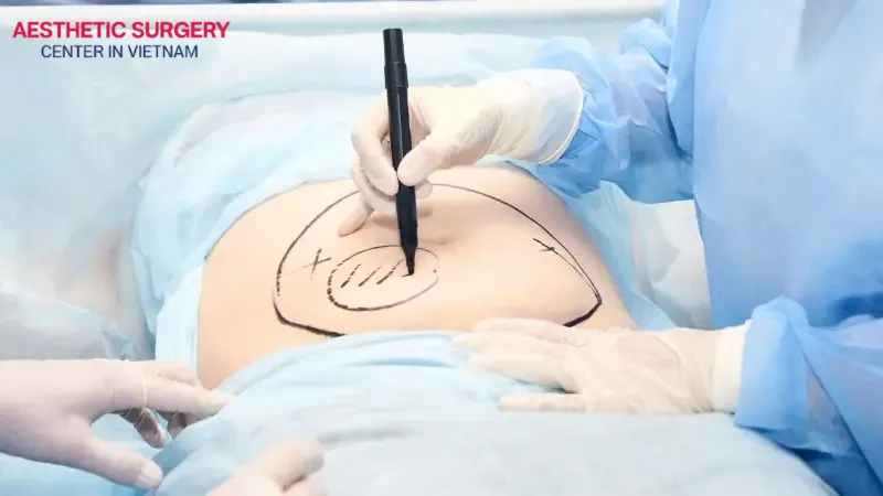 The greater the fat volume, the longer the procedure and the stricter the requirements