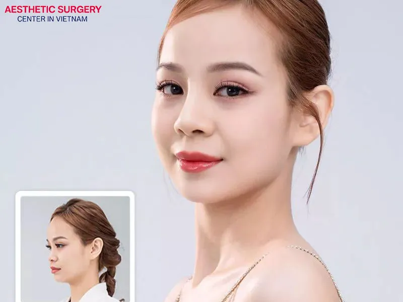 Aesthetic Surgery Center is proud to be a provider of high-quality rhinoplasty services in Vietnam